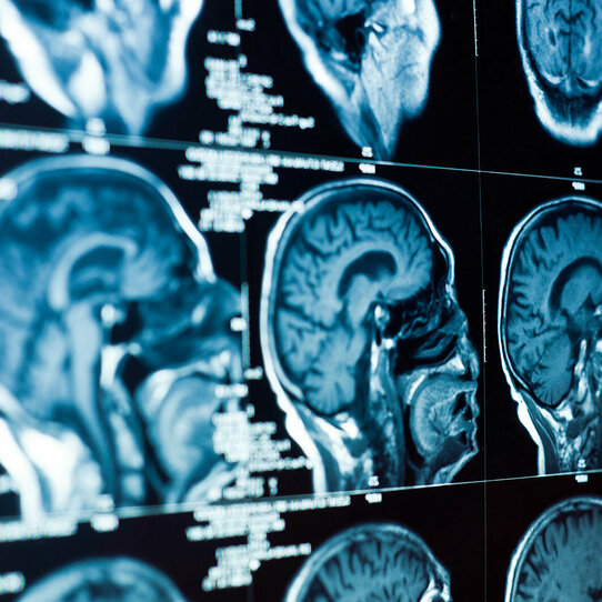 CT-Aufnahme eines Schädels mit Gehirn