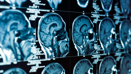 CT-Aufnahme eines Schädels mit Gehirn